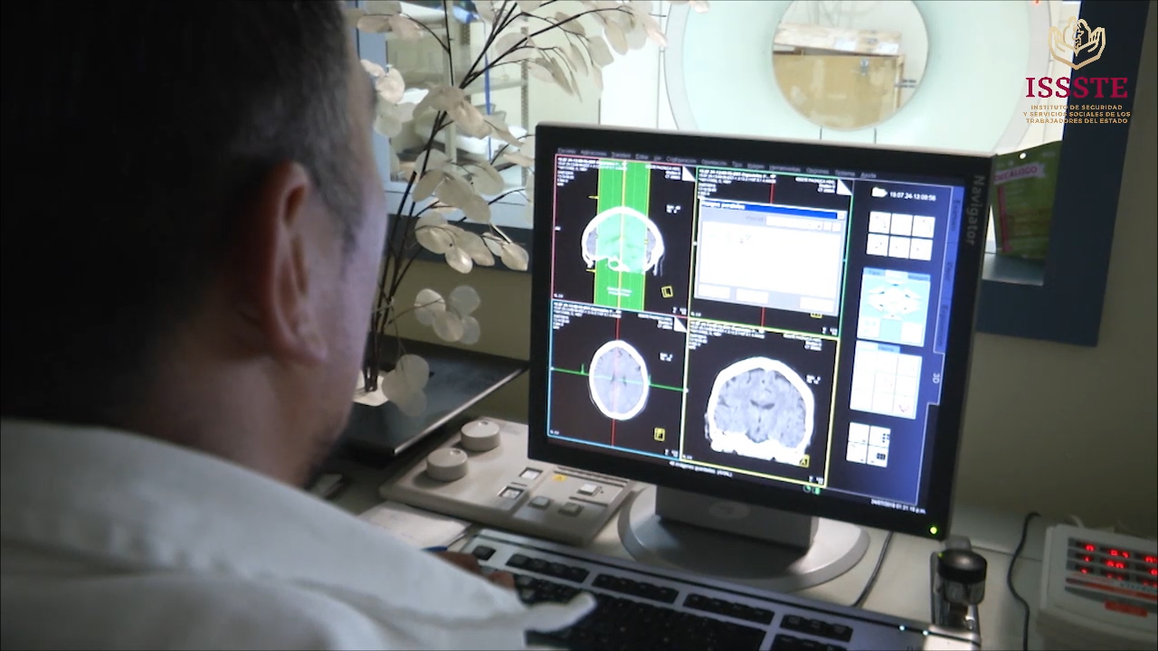 ISSSTE destaca trabajo ante infartos cerebrales