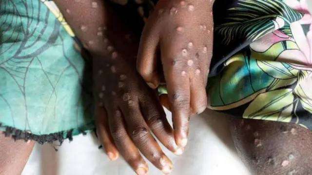 OMS lanza plan estratégico global para detener brotes de Mpox