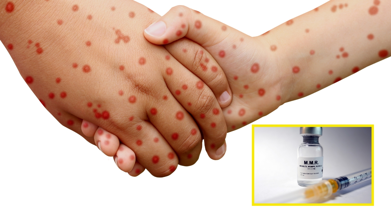 Hidalgo en riesgo de sarampión: Vanesa Escalante