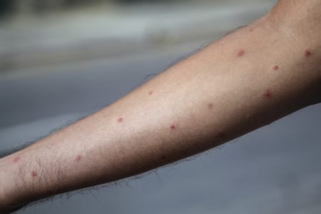 Hidalgo duplica casos de viruela símica en julio