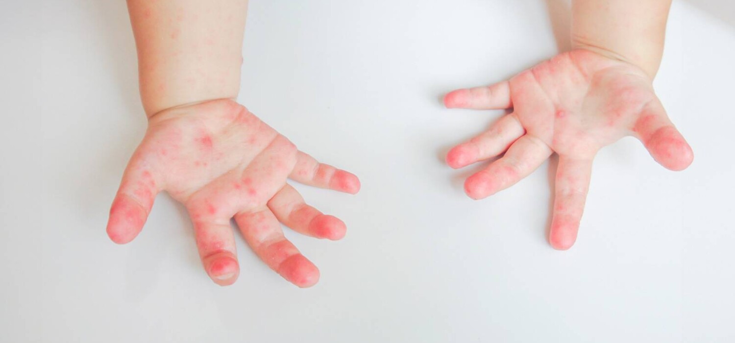 Reportan 38 casos de coxsackie en Tula; niños de preescolar, los más afectados