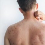 Casos de Sarampión en Hidalgo