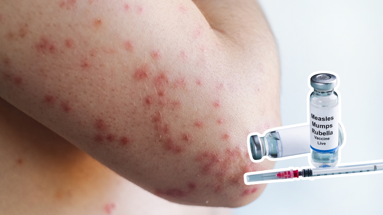 Personal de salud aplica vacuna contra el sarampión